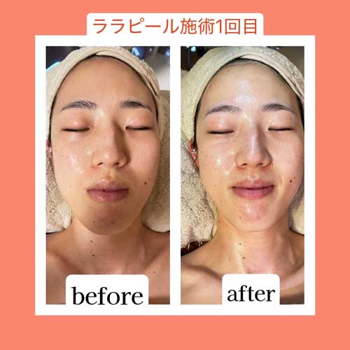 ララピールの施術前後を並べた写真